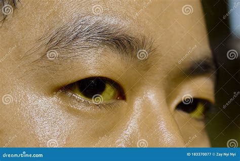 东南亚青年皮肤黄斑、巩膜或黄疸 库存图片 图片 包括有 故障 酒客 肝脏 炎症 汉语 含毒物 183370077