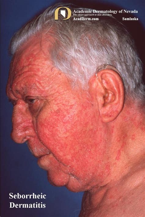 Seborrheic Dermatitis Dandruff Cradle Cap Academic Dermatology