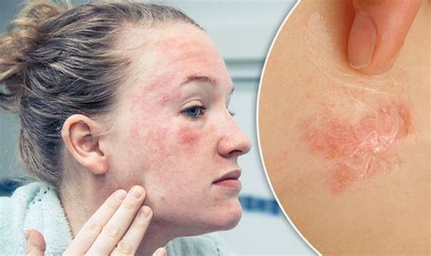 How To Get Rid Of Eczema On The Face Get Rid Of Eczema Eczema
