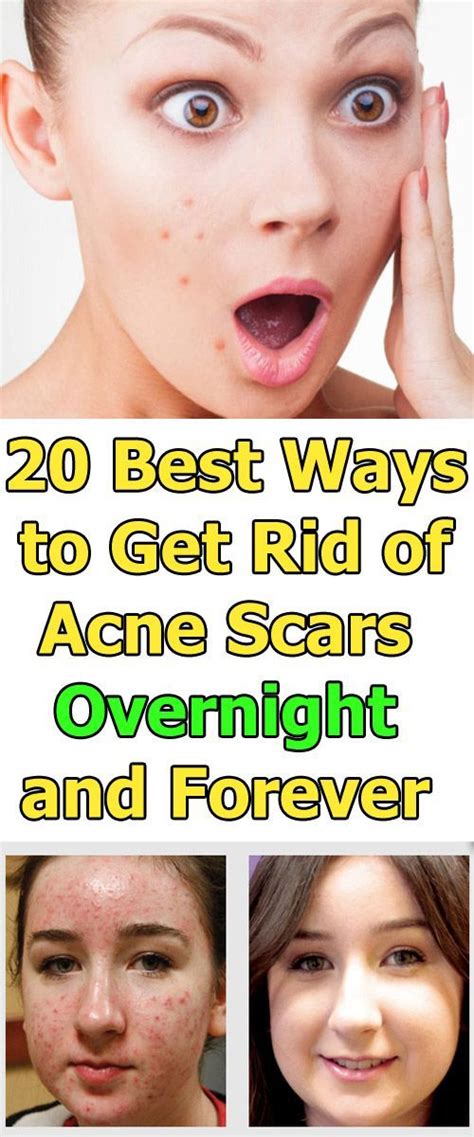 How To Get Rid Of Red Acne Scars Overnight Naturally