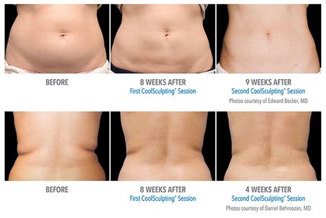 Coolsculpting In Mn Freeze Fat Cells To Reshape Your Body