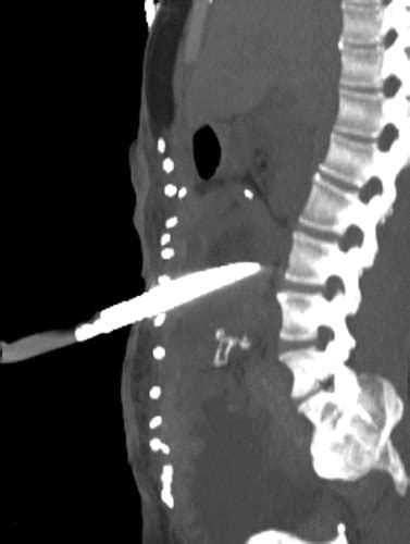 Ct Of Penetrating Abdominopelvic Trauma Radiographics