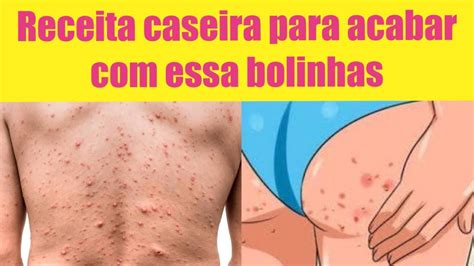 Como Acabar Bolinhas No Bumbum Receita Caseira