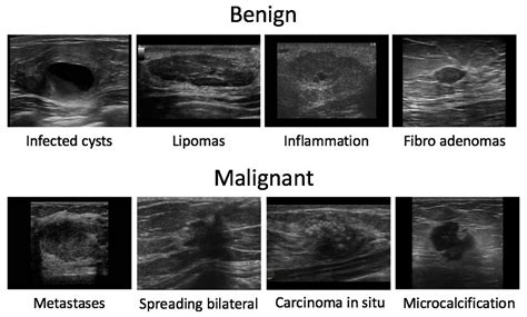 For the other types, a lump is the best indicator. Automating Breast Cancer Detection with Deep Learning
