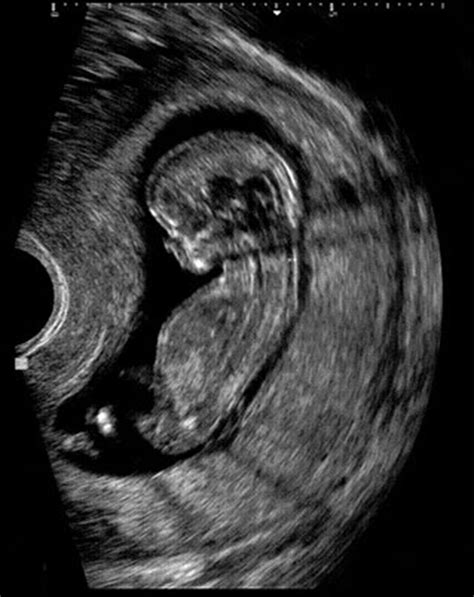 2 Ultraschall Schwangerschaft Captions Save