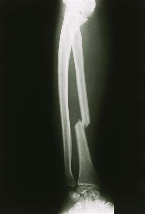 X Ray Of The Right Forearm Showing Radius Fracture Photograph By James