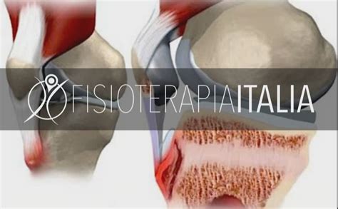 Il morbo di osgood schlatter cause e rimedi