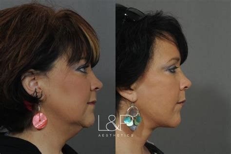 Facelift And Neck Lift Before And After Photos Case 33 Palo Alto And San