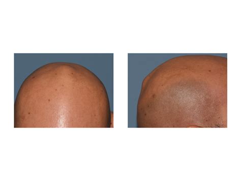 Blog Archivecase Study Reduction Of The Vertex Skull Bump