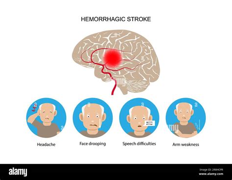 Hemorrhagic Stroke And Warning Signs And Symptoms Vector Illustration