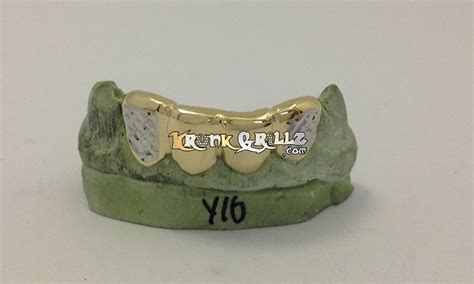 Damage from a poorly fitting grill. Side Border Diamond Cut Grillz