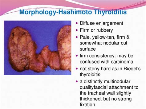 Lect 3 Thyroid Disorders