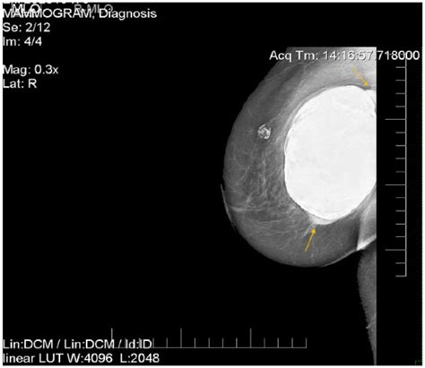 sonographic confirmation of intracapsular and extracapsular breast implant rupture hannah l