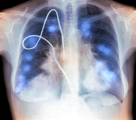 Secondary Lung Cancers X Ray Photograph By Du Cane Medical Imaging Ltd