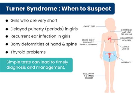 Turner Syndrome Chest