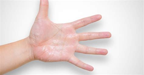 Hyperhidrosis Symptoms Causes And Treatments Health Panel