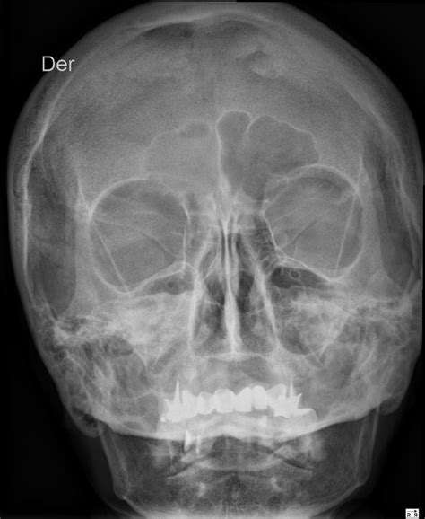 Pin On Radiología Del Cráneo