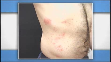 The Fix For Summer Skin Problems Like Poison Ivy Bug Bites Wdrb 41