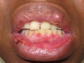 We did not find results for: Mouth ulcer | DermNet NZ