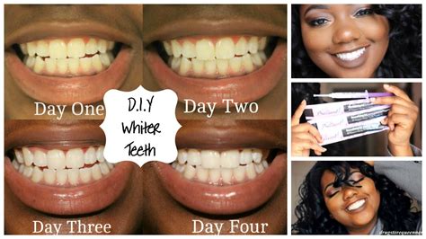 If you're confined to wearing braces in the first place, is it really too much to ask that the parts of your teeth that aren't covered in metal be. D.I.Y. How to Get Whiter Teeth at Home | Smile Brilliant ...