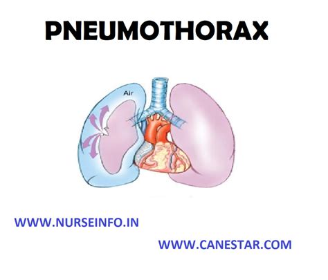 Pneumothorax Nurse Info