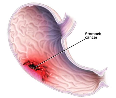 Learn what signs & symptoms of stomach cancer to watch out for such as a poor appetite, weight loss, belly pain, or heartburn. Stomach cancer - Symptoms, causes and other risk factors