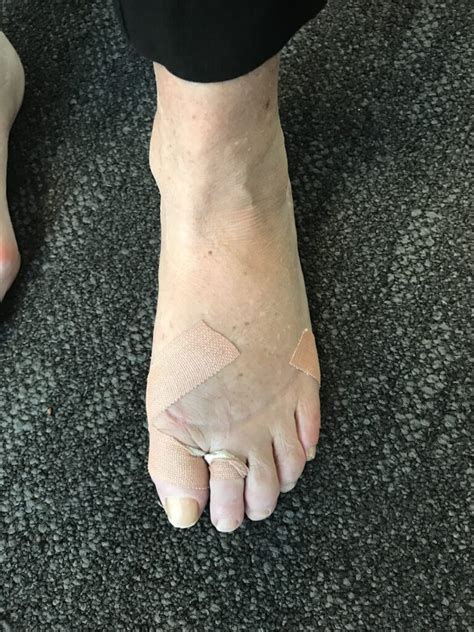 Post Op Treatment For Bunions Orthopaedic Surgeon Australia