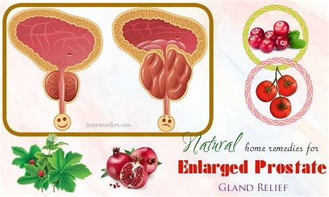 57 Home Remedies For Enlarged Prostate Gland Relief