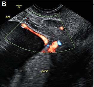 Below, learn about the types, symptoms, and risks of this issue and how doctors. Placenta | New Zealand Obstetric Ultrasound Guidelines ...