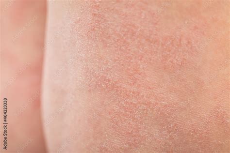 Close Up Severe Atopic Eczema On The Legs Behind The Knees Of A Child
