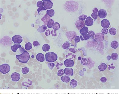 Figure 3 From Acute Myeloid Leukaemia M6b Pure Acute Erythroid