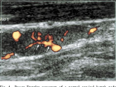 Figure 3 From Sonography Of Neck Lymph Nodes Part Ii Abnormal Lymph