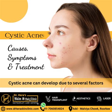 Cystic Acne Causes Symptoms And Treatment Dermatologist In Roorkee