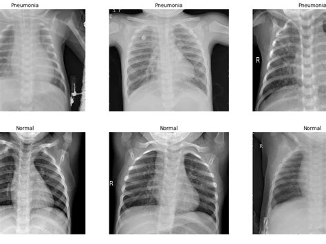 identifying viral  bacterial pneumonia  chest  ray images