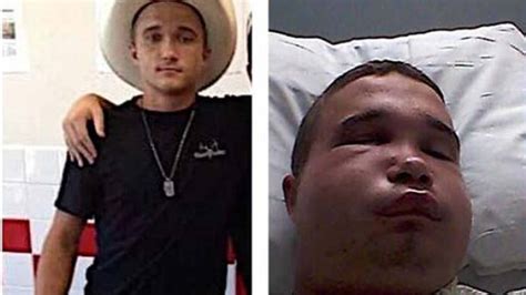 Florida man recovering after bite to face by deadly snake – 104.5 WOKV