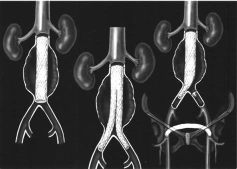 Endovascular Repair Of Abdominal Aortic Aneurysms Ochsner Journal