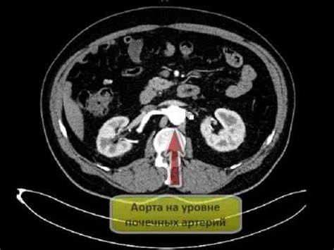 Диета аневризма брюшной аорты КТ брюшной полости (аневризма брюшной аорты) - YouTube КТ брюшной полости (аневризма брюшной аорты) - YouTube Диета аневризма брюшной аорты