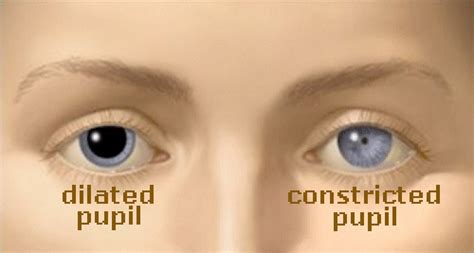 Dilated And Constricted Pupils