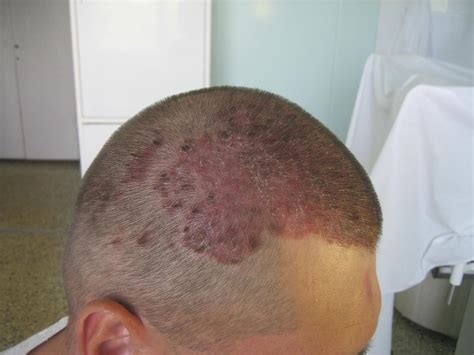 Photos Of Scalp Psoriasis Symptoms And Pictures