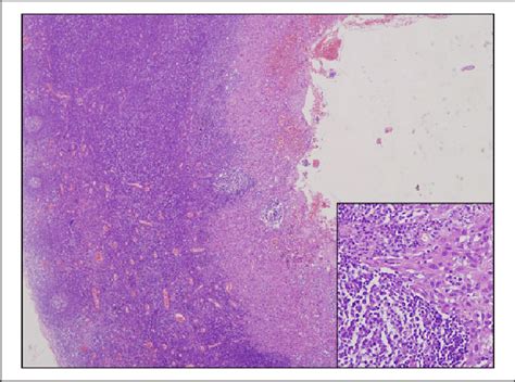 Typical Squamous Cell Carcinoma Metastasis Into The Lymph Node