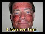 Images of Recovery Time Co2 Laser Skin Resurfacing