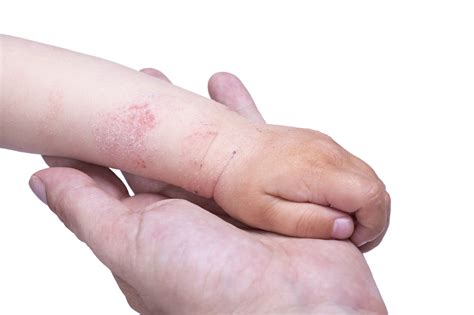Dermatite Atopica Eczema Amico Pediatra
