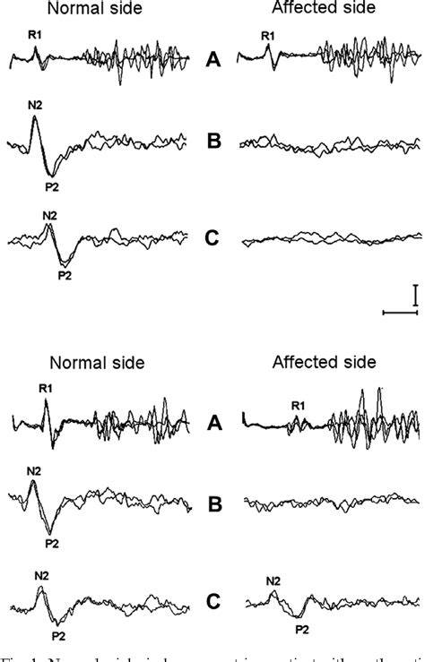 Figure 1 From Pathophysiology Of Pain In Postherpetic Neuralgia A