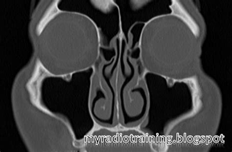 Radiology Info Hub Normal Variants Paranasal Sinuses
