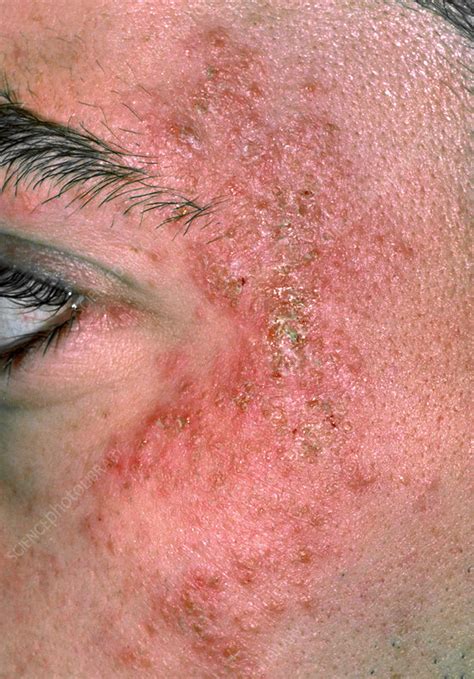 Eczema On The Side Of A Mans Face Stock Image M1500121 Science