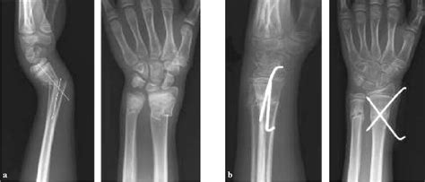 Figure From Distal Radius Fractures Nonoperative And Percutaneous My