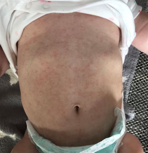 Wer großen arbeit mit der analyse auslassen will, möge sich an eine empfehlung in dem wann steigt das fieber am höchsten check. Nach Fieber Ausschlag | Forum Gesundheit & Medizin - urbia.de