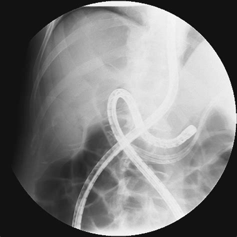 Therapeutic Ercp With The Double Balloon Enteroscope In Patients With