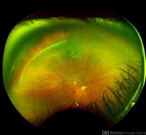 Giant Retinal Tear Retina Image Bank