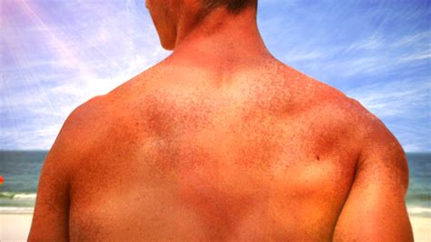 Doctors Reminding People Of The Dangers Of Excessive Sun Exposure On